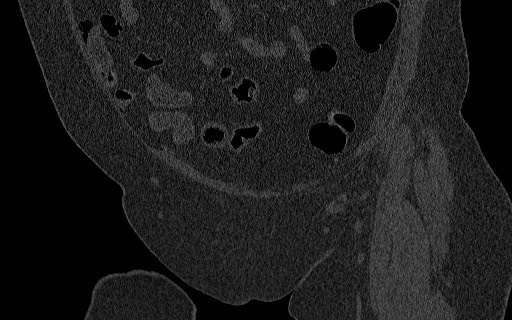 File:Breast carcinoma with pathological hip fracture (Radiopaedia 60314-67993 Coronal bone window 44).jpg