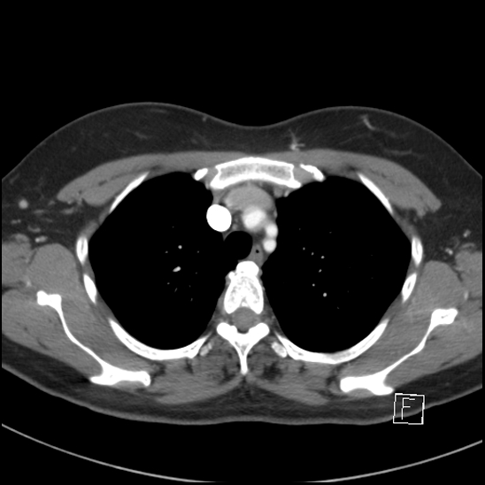 File:Breast metastases from renal cell cancer (Radiopaedia 79220-92225 A 24).jpg
