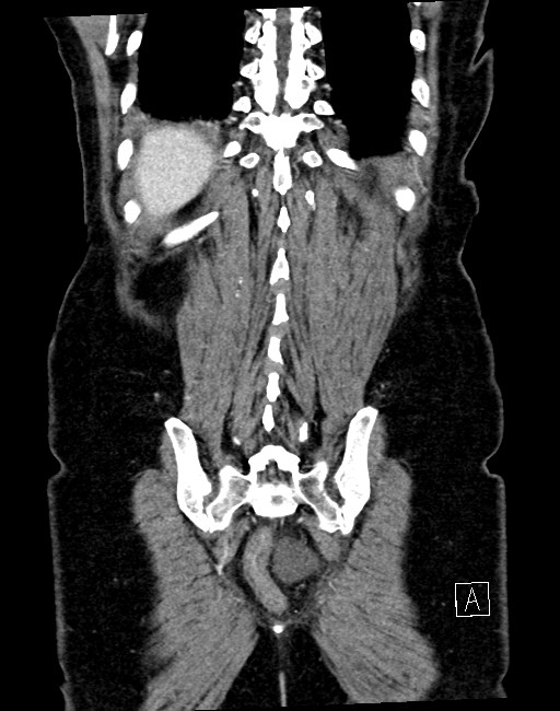 Broad ligament hernia (Radiopaedia 84802-100276 B 5).jpg