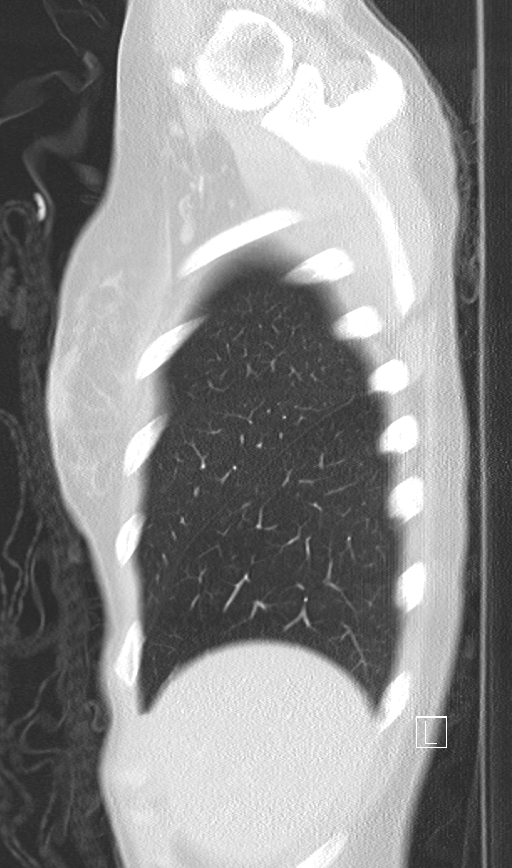Bronchial atresia (Radiopaedia 73677-84470 Sagittal lung window 6).jpg
