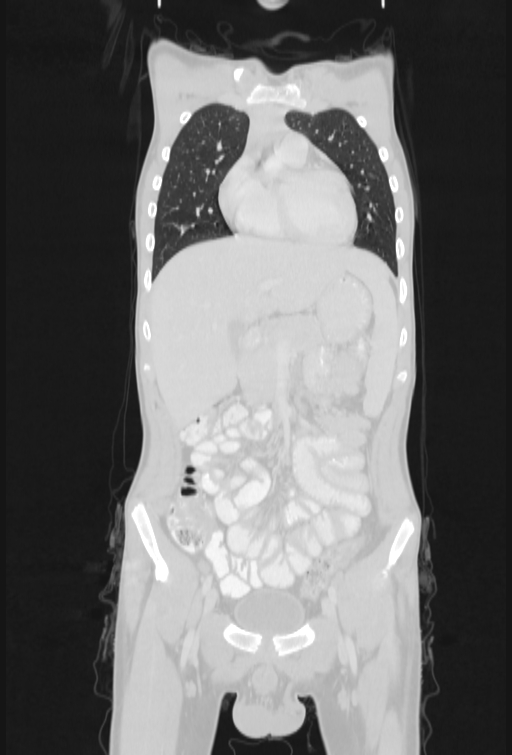 Bronchial carcinoid tumor (Radiopaedia 57187-64090 Coronal lung window 26).jpg
