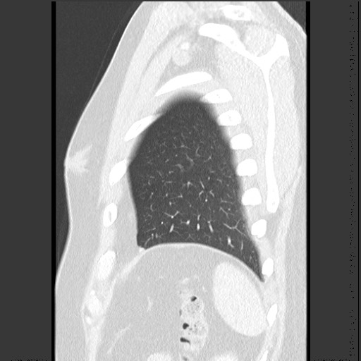 Bronchial carcinoid tumor (Radiopaedia 67377-76764 Sagittal lung window 60).jpg
