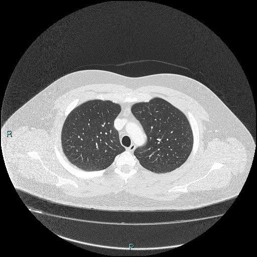 Bronchial carcinoid tumor (Radiopaedia 78272-90875 Axial lung window 11).jpg