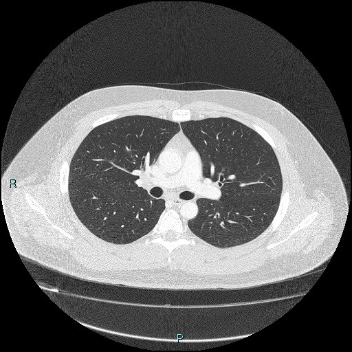 Bronchial carcinoid tumor (Radiopaedia 78272-90875 Axial lung window 20).jpg