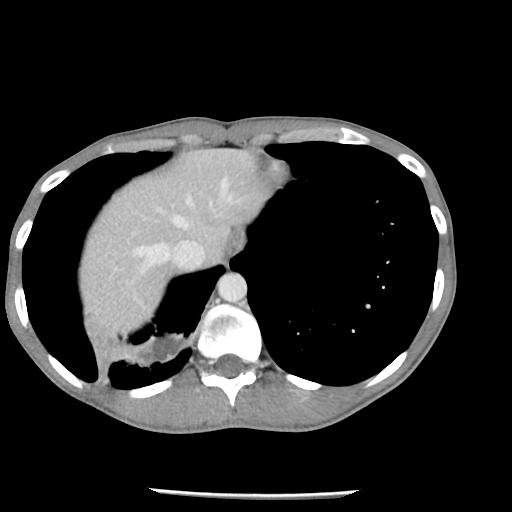 Bronchial carcinoid tumor causing right lower lobe collapse (Radiopaedia 83495-98594 A 45).jpg