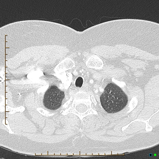 Bronchial diverticula (Radiopaedia 79512-92676 Axial lung window 8).jpg