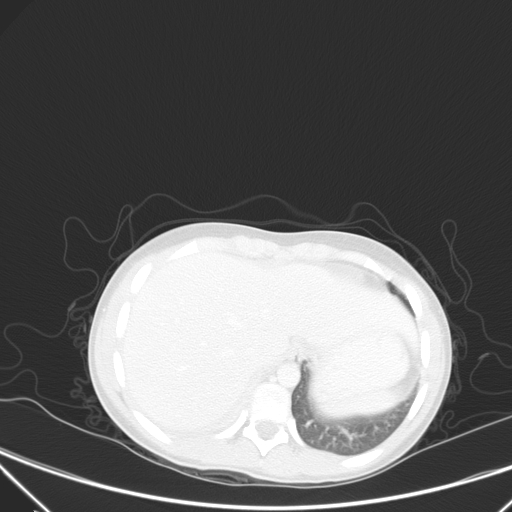 Bronchial mucoepidermoid carcinoma (Radiopaedia 57023-63895 Axial lung window 101).jpg