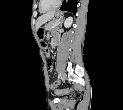 File:Bronchiectasis in Crohn disease (Radiopaedia 60311-67977 D 73).jpg