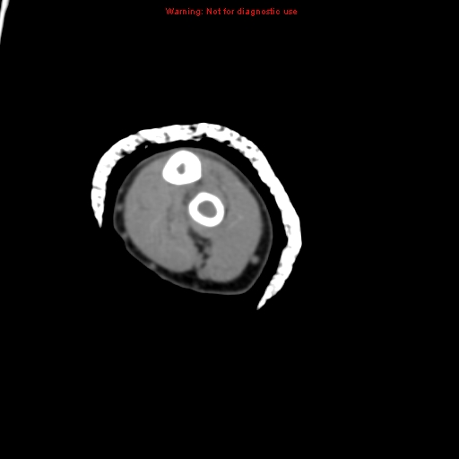 Brown tumor (Radiopaedia 12460-12694 Axial non-contrast 111).jpg