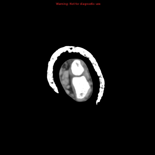 Brown tumor (Radiopaedia 12460-12694 Axial non-contrast 21).jpg