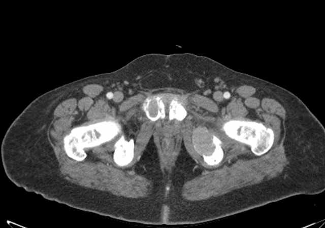 Brown tumors compressing the spinal cord (Radiopaedia 68442-77988 E 127).jpg