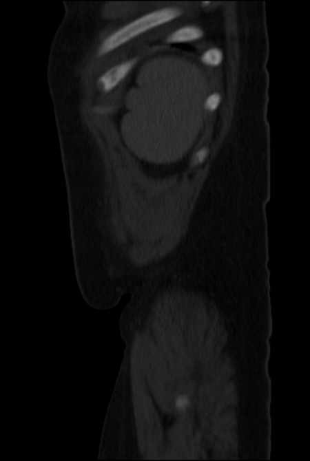 Brown tumors compressing the spinal cord (Radiopaedia 68442-77988 H 52).jpg