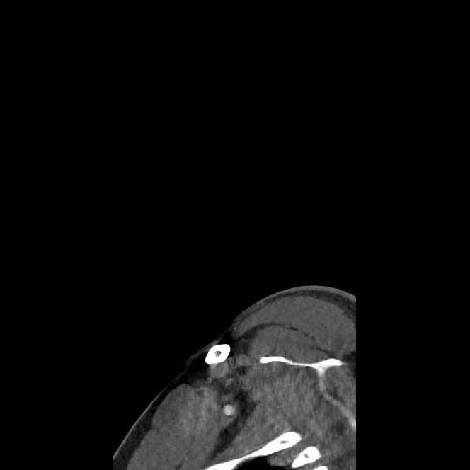 Buccal fat pad arteriovenous malformation (Radiopaedia 70936-81144 C 9).jpg