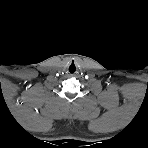 Buccal fat pad arteriovenous malformation (Radiopaedia 70936-81144 D 85).jpg
