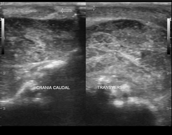 File:Buccal mucosal retention cyst on sonography (Radiopaedia 12196-12521 B 1).jpg