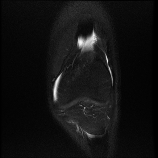 File:Bucket-handle meniscus tear (Radiopaedia 65700-74809 Coronal T2 fat sat 17).jpg