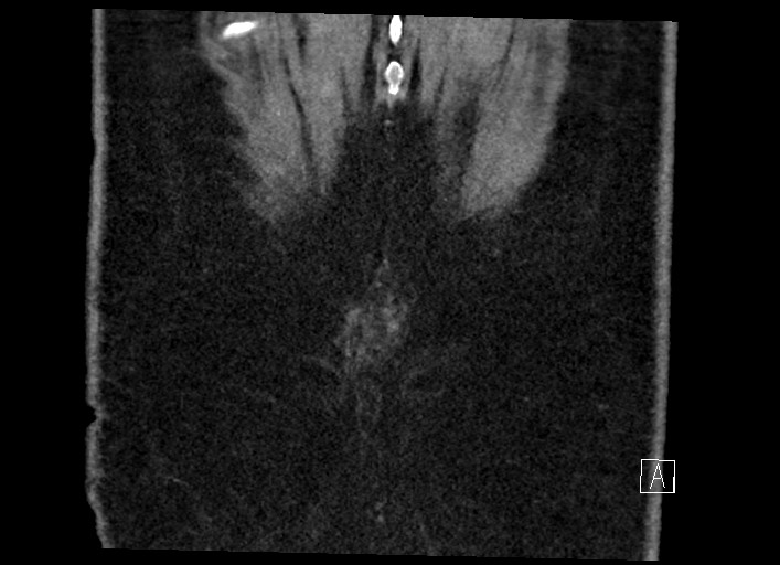 Buried bumper syndrome - gastrostomy tube (Radiopaedia 63843-72577 Coronal Inject 137).jpg