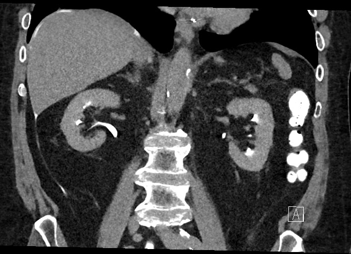 File:Buried bumper syndrome - gastrostomy tube (Radiopaedia 63843-72577 Coronal Inject 80).jpg