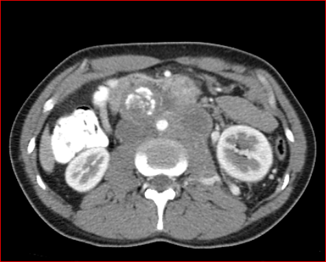 File:Burned-out testicular choriocarcinoma (Radiopaedia 32822-34040 B 10).PNG