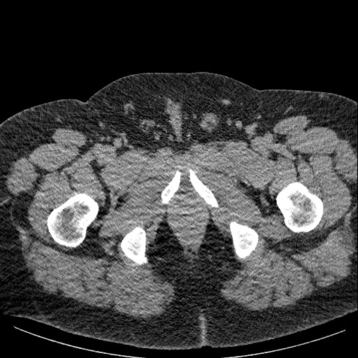 File:Burned-out testicular seminoma - retroperitoneal nodal metastases (Radiopaedia 62872-71245 A 75).jpg
