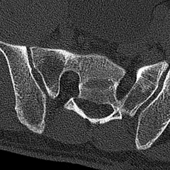 Burst fracture (Radiopaedia 53373-59357 Axial bone window 75).jpg