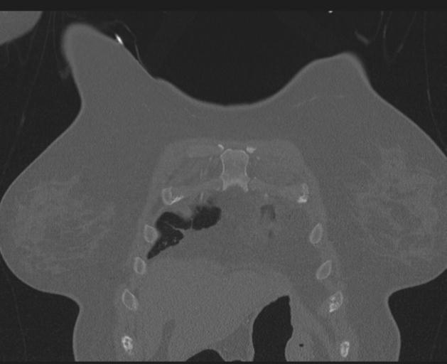 File:Burst fracture - thoracic spine (Radiopaedia 30238-30865 Coronal bone window 28).jpg