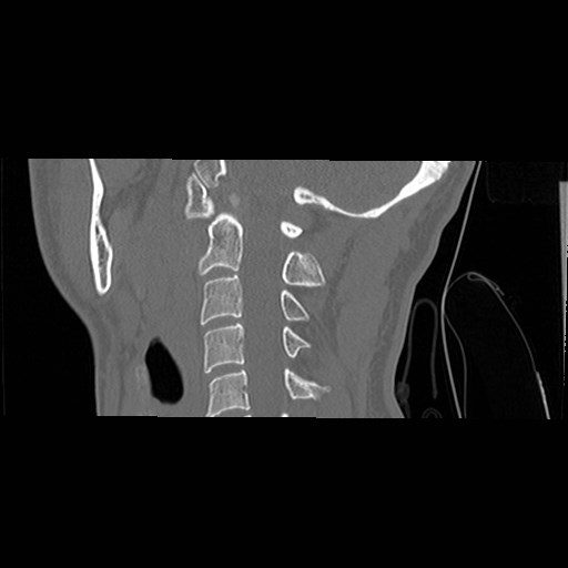 File:C1-C2 "subluxation" - normal cervical anatomy at maximum head rotation (Radiopaedia 42483-45607 C 29).jpg