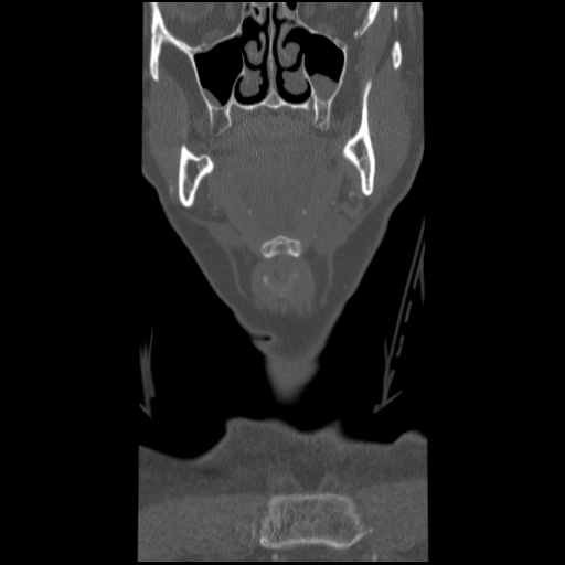C1 anterior arch (plough) fracture - type 1 (Radiopaedia 76181-87720 Coronal bone window 92).jpg