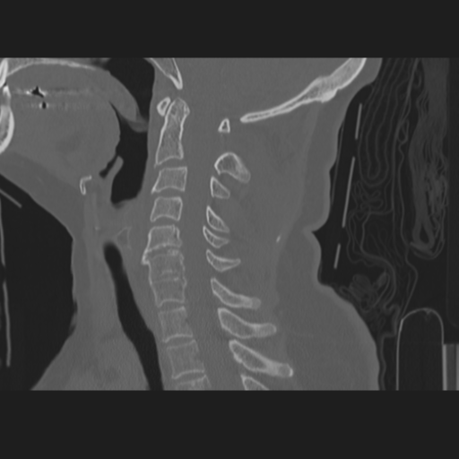 File:C2 fracture (Radiopaedia 34091-35341 Sagittal bone window 38).png