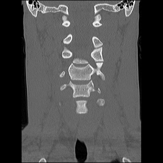 C5 facet fracture (Radiopaedia 58374-65499 Coronal bone window 27).jpg