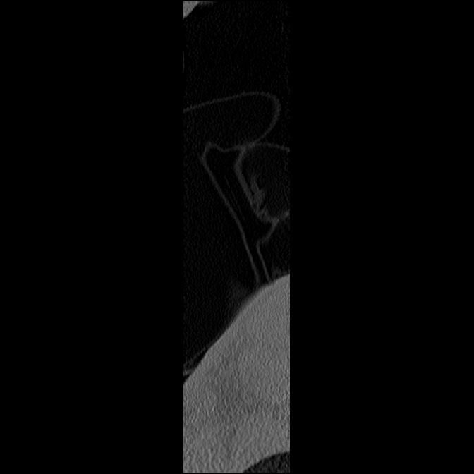 C5 facet fracture (Radiopaedia 58374-65499 Sagittal bone window 73).jpg