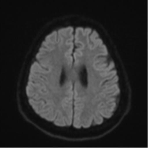 File:CNS vasculitis (Radiopaedia 55715-62263 Axial DWI 50).png