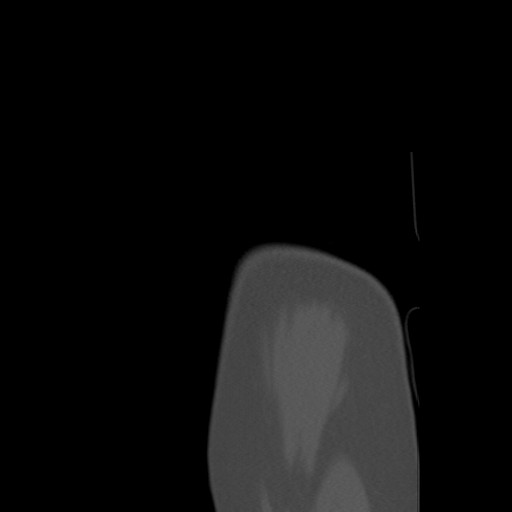 File:Calcific tendinitis of the infraspinatus tendon (Radiopaedia 87256-103539 Sagittal bone window 7).jpg