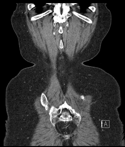 Calcified adrenal glands and Spigelian hernia (Radiopaedia 49741-54988 B 109).jpg