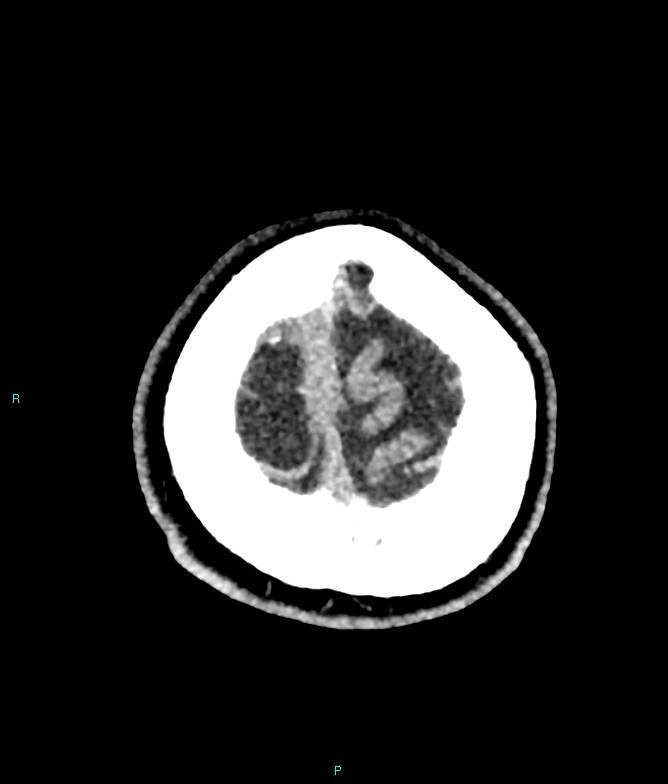 Calcified cerebral emboli from left ventricular thrombus (Radiopaedia 84420-99758 Axial non-contrast 9).jpg
