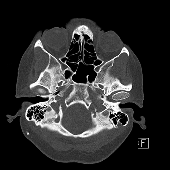 File:Calcified chronic subdural hematoma (Radiopaedia 77374-89492 Axial bone window 18).jpg