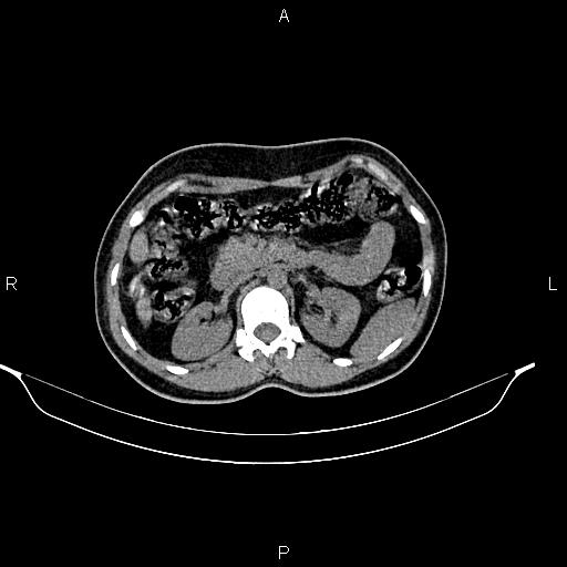 File:Calcified hepatic hydatid cyst (Radiopaedia 84672-100095 Axial non-contrast 39).jpg