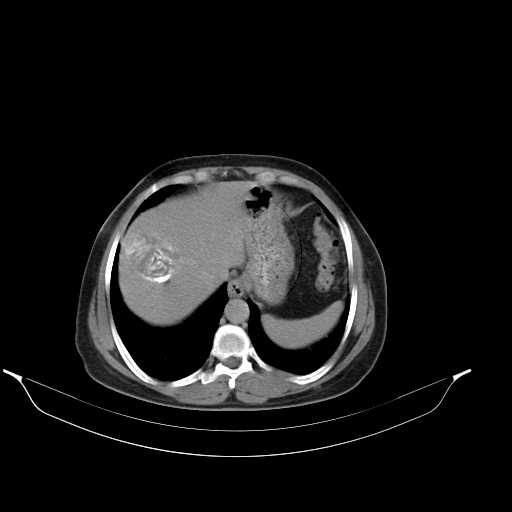 File:Calcified hydatid cyst of the liver (Radiopaedia 21212-21112 Axial C+ delayed 10).jpg