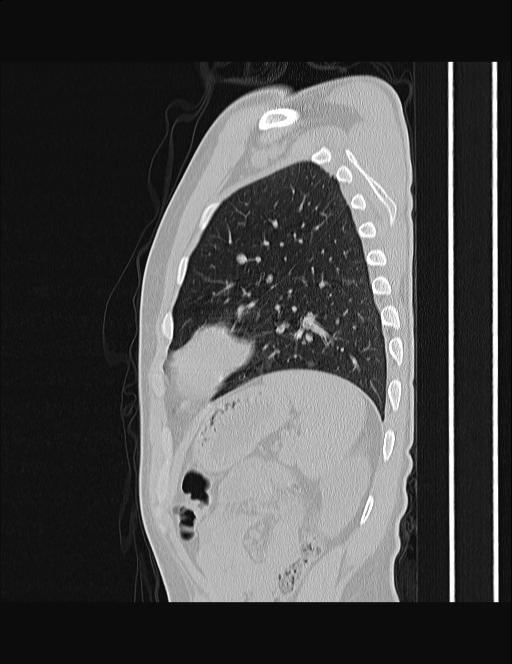 Calcifying pulmonary metastases (Radiopaedia 33359-34396 Sagittal lung window 16).jpg
