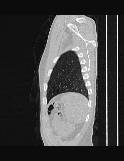 Calcifying pulmonary metastases (Radiopaedia 33359-34396 Sagittal lung window 8).jpg
