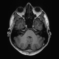 Callosal dysgenesis with interhemispheric cyst (Radiopaedia 53355-59335 Axial T1 37).jpg