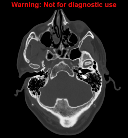 File:Calvarial thickening from chronic shunting (Radiopaedia 60079-67637 Axial bone window 30).jpg