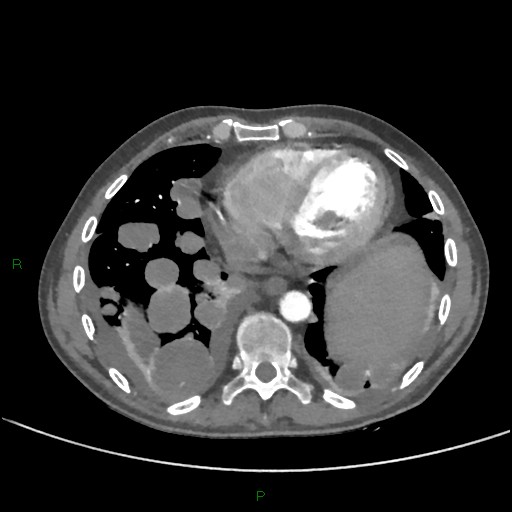 Cannonball metastases (Radiopaedia 82110-96150 Axial C+ CTPA 238).jpg
