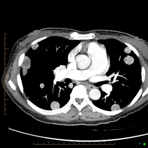 File:Canonball lung metastasis (Radiopaedia 77634-89837 B 45).jpg