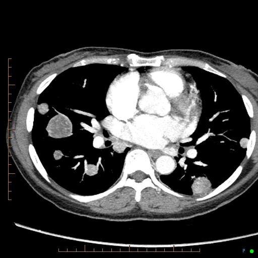 Canonball lung metastasis (Radiopaedia 77634-89837 B 52).jpg