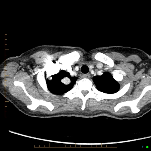 Canonball lung metastasis (Radiopaedia 77634-89837 B 7).jpg