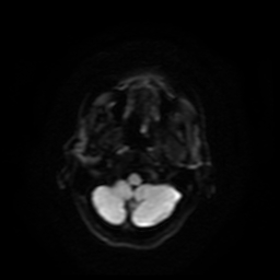 Carcinoma ex-pleomorphic adenoma of parotid (Radiopaedia 28383-28627 Ax DWI B-500 GE 58).jpg