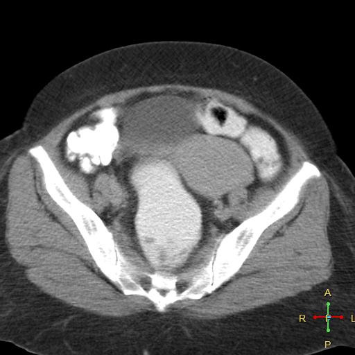 File:Carcinoma of sigmoid colon (Radiopaedia 23071-23100 C+ delayed 22).jpg