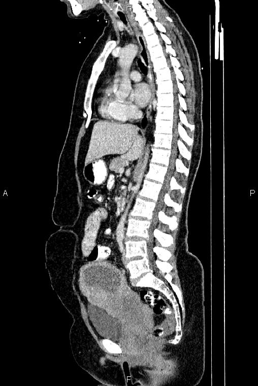 Carcinoma of uterine cervix (Radiopaedia 85861-101700 D 42).jpg