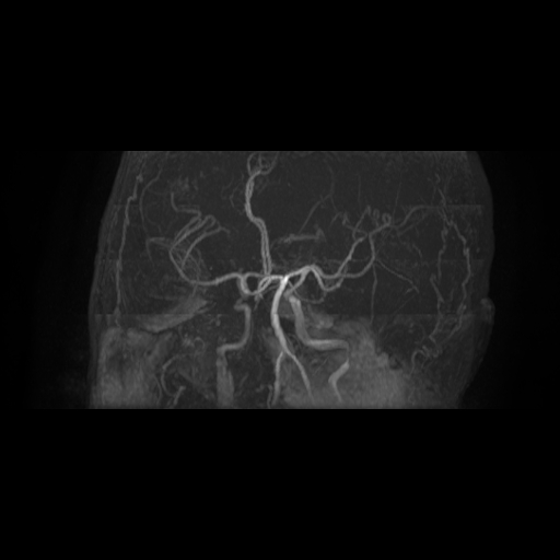 Carotid arterial dissection with acute cerebral infarction (Radiopaedia 26636-26784 MRA 9).jpg